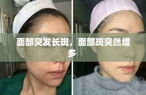 面部突发长斑，面部斑突然增多 