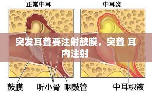 突发耳聋要注射鼓膜,突聋 耳内注射