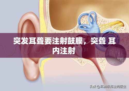 突发耳聋要注射鼓膜,突聋 耳内注射