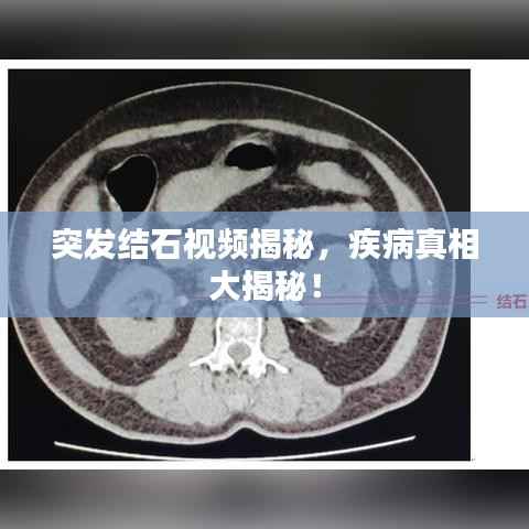 突发结石视频揭秘，疾病真相大揭秘！