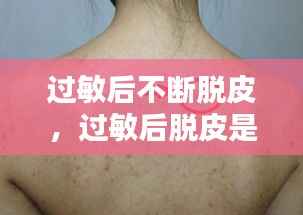 过敏后不断脱皮,过敏后脱皮是好是坏啊