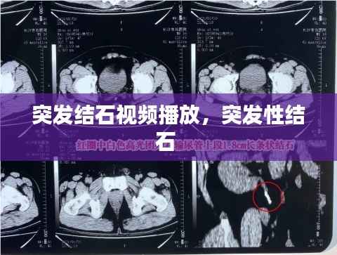突发结石视频播放，突发性结石 