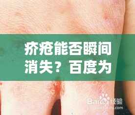疥疮能否瞬间消失?百度为你解答