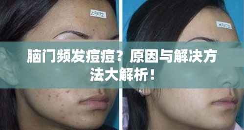 脑门频发痘痘?原因与解决方法大解析!