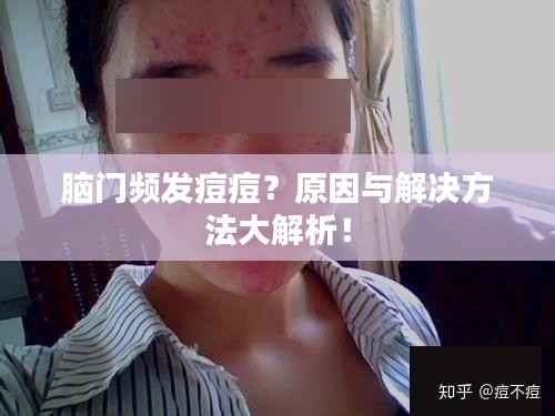 脑门频发痘痘?原因与解决方法大解析!